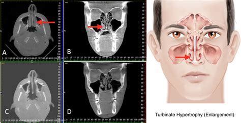 A comparative study of partial inferior turbinectomy, submucosal diathermy and inferior <b>turbinate</b> bone resection for inferior <b>turbinate</b> <b>hypertrophy</b>. . Hypertrophy of nasal turbinates va rating